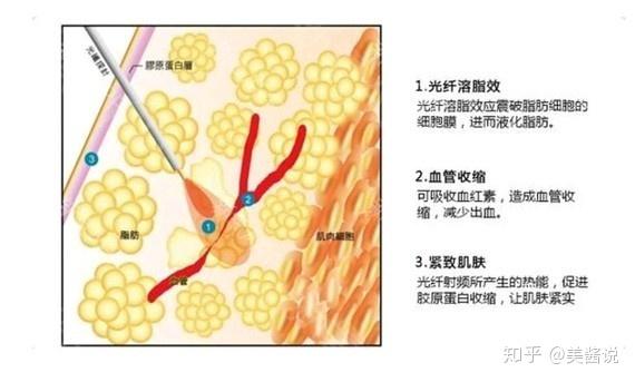 最新溶脂术，重塑身材的革新方法